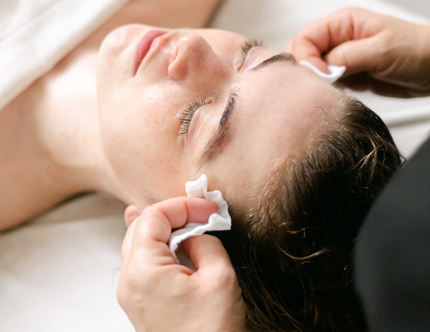 Microneedling with PDRN